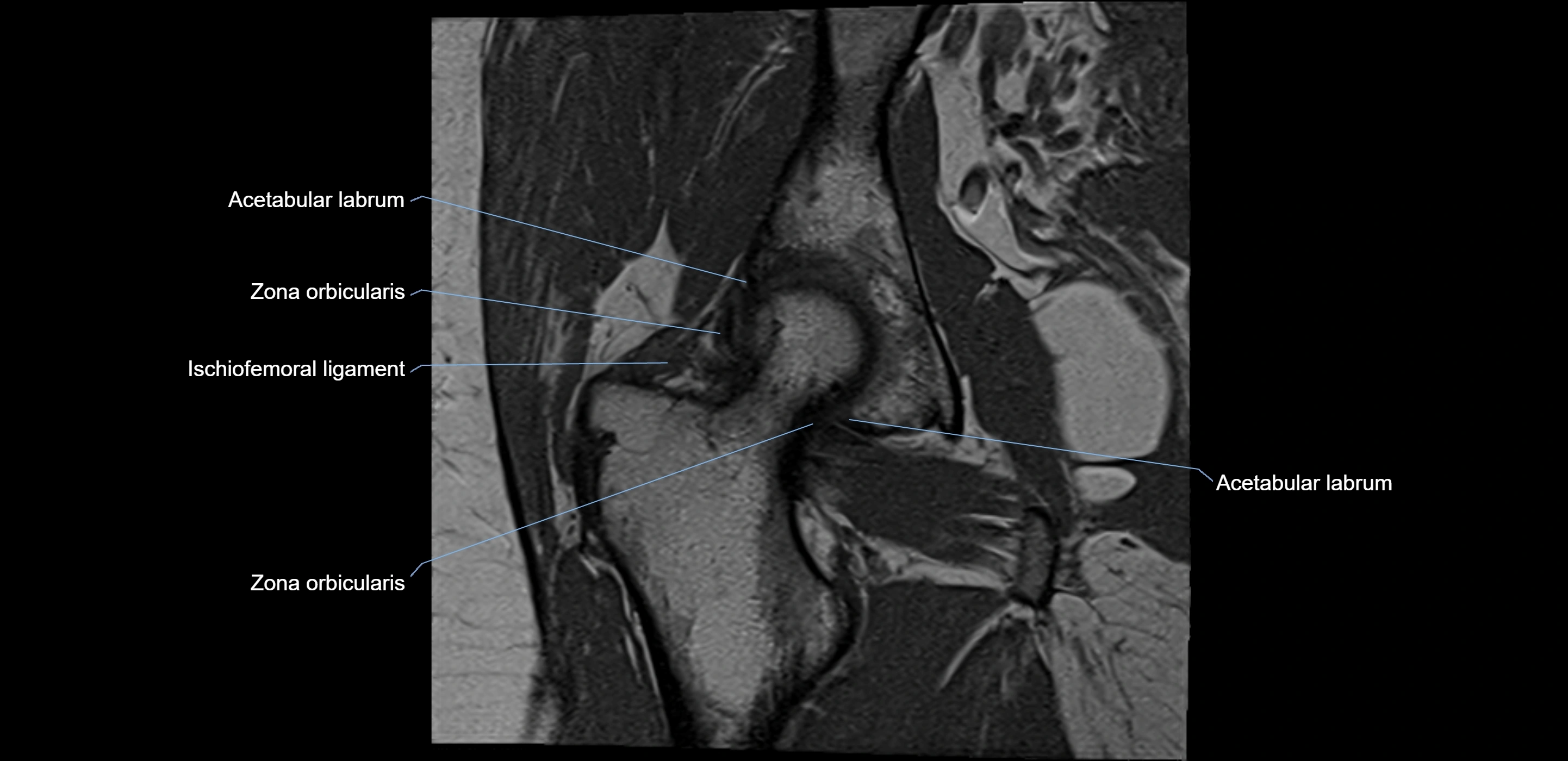 MRI Hip ligaments coronal cross sectional anatomy 3T  radiology  image-img-00001-00017.webp